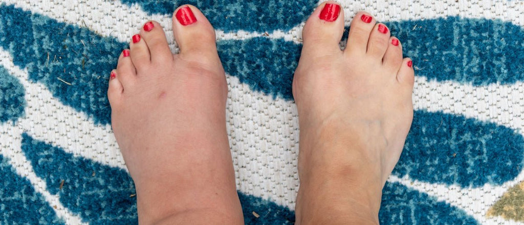 Elderly woman with swollen feet