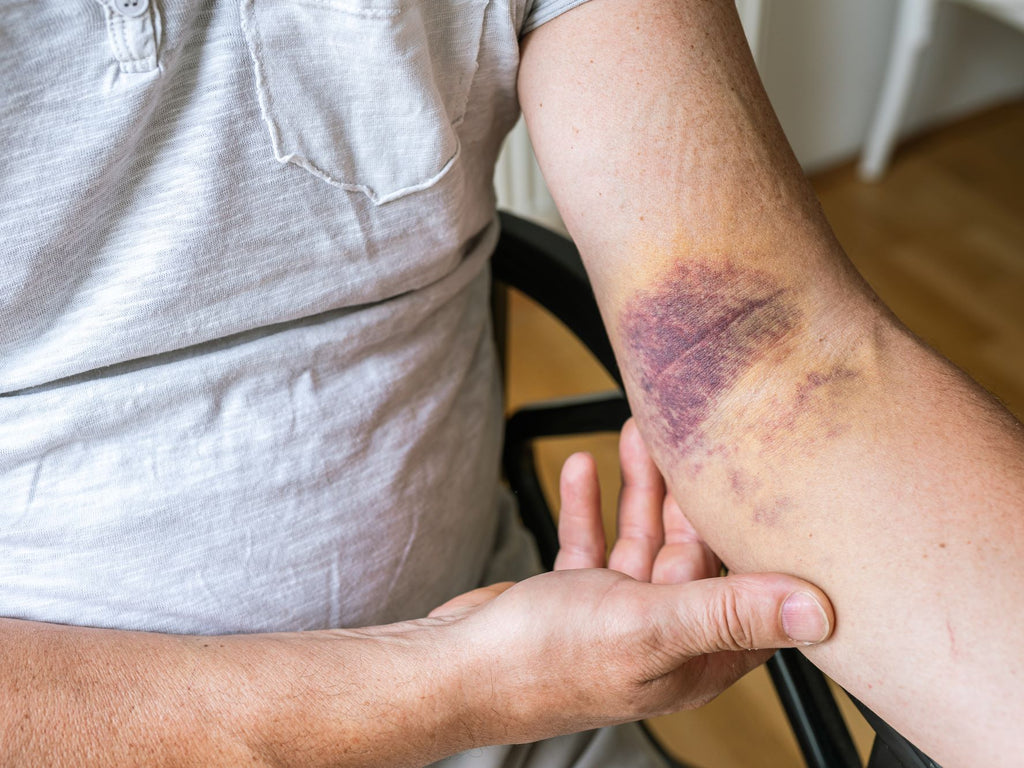Elderly with skin discolouration due to bruises
