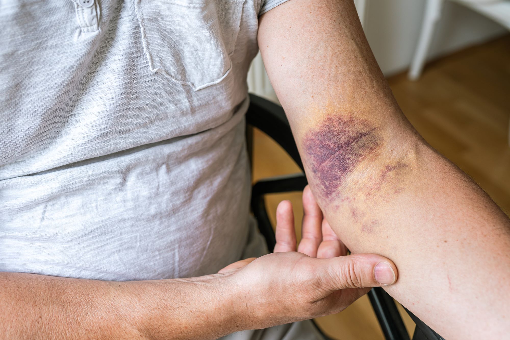Elderly with skin discolouration due to bruises