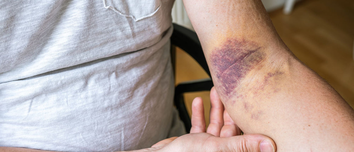 Elderly with skin discolouration due to bruises